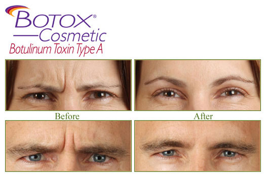 botox