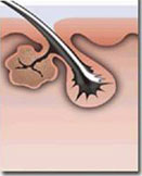 laser - dermaden sanok